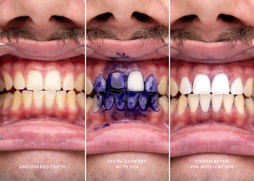 New V34 Whitening Strips