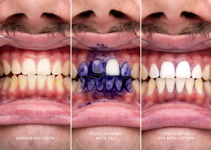 New V34 Whitening Strips
